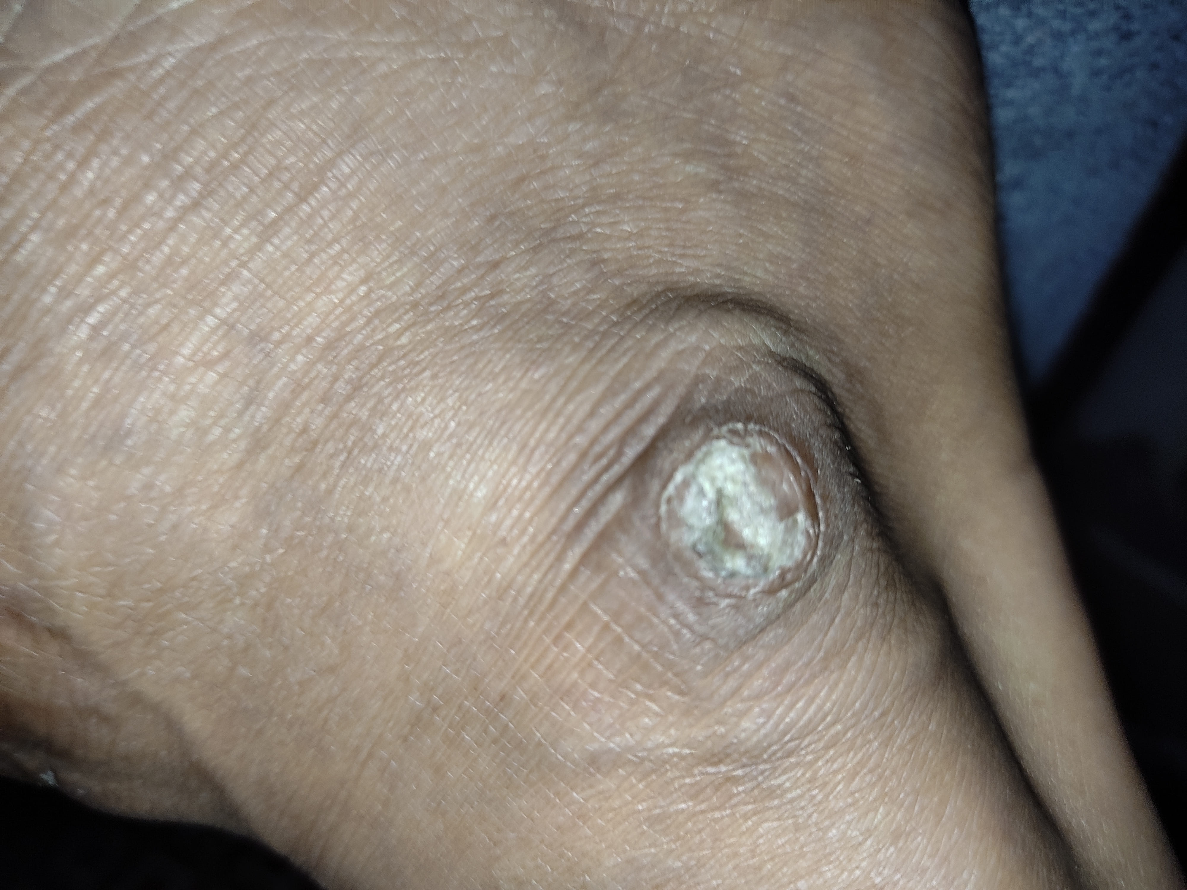 swollen, blisters formed