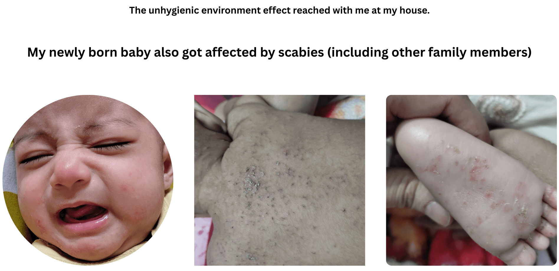 Scabies to my newly borned baby