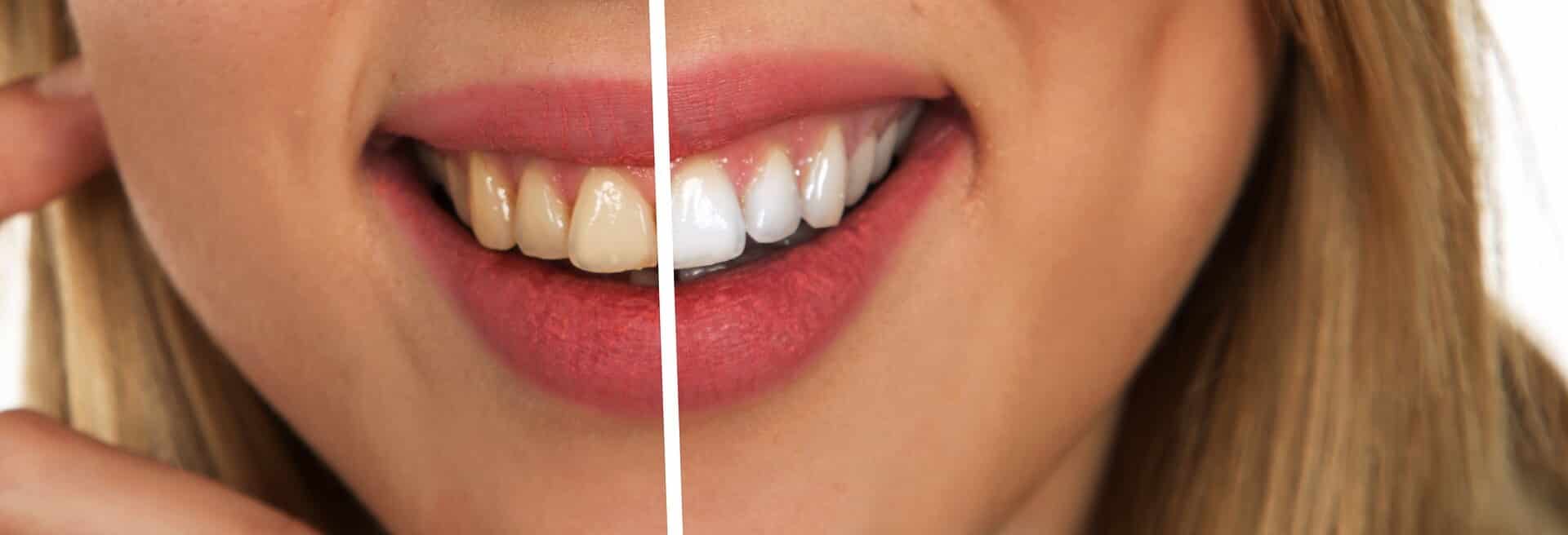 Teeth before and after photo